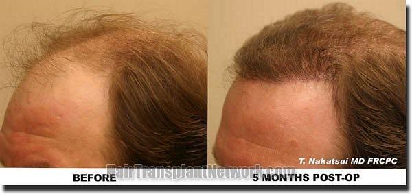 Hair restoration procedure results