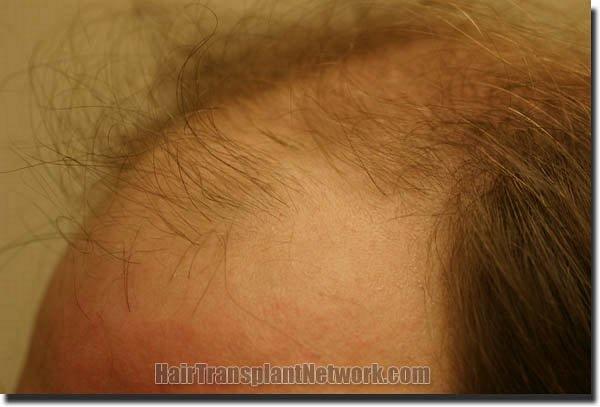 Hair restoration procedure results