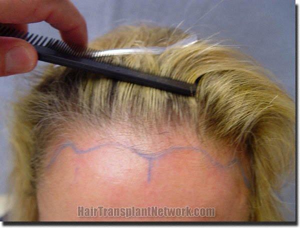 Hair restoration procedure results