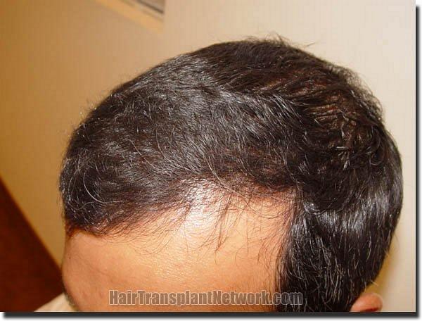 Hair restoration procedure results