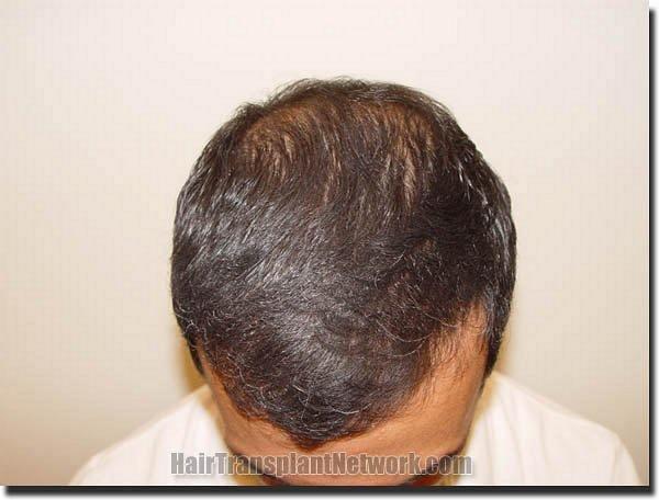 Hair restoration procedure results