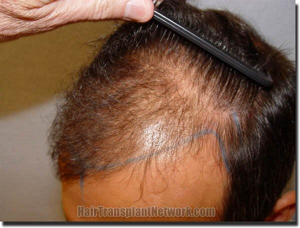 Hair restoration procedure results