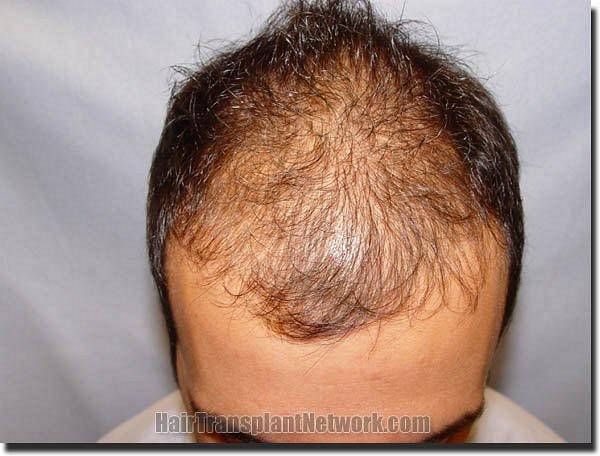 Hair restoration procedure results