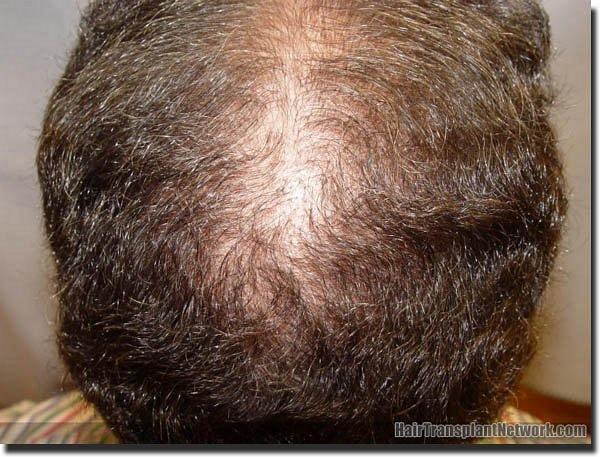 Hair restoration procedure results