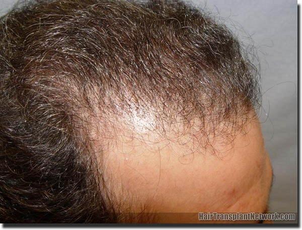 Hair restoration procedure results