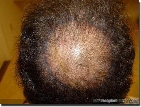 Hair restoration procedure results