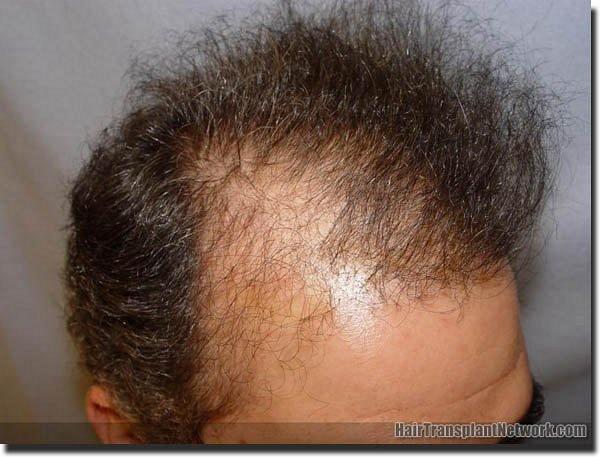 Hair restoration procedure results