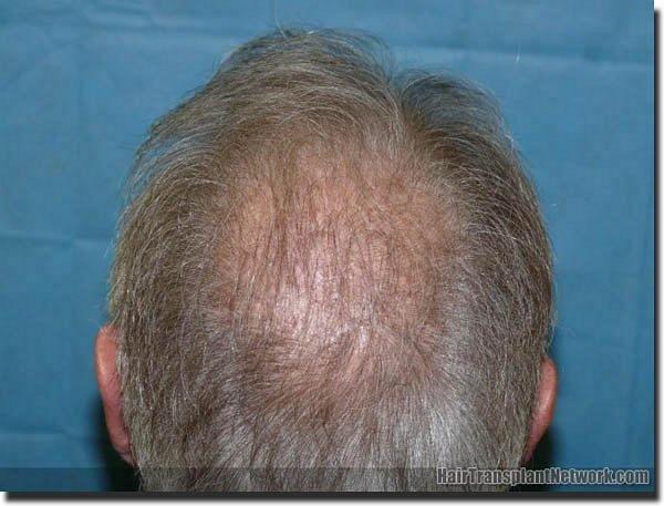 Hair restoration procedure results