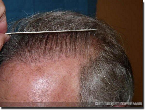 Hair restoration procedure results