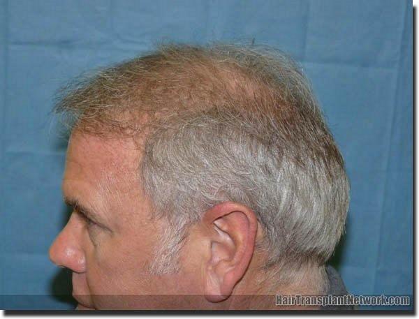 Hair restoration procedure results