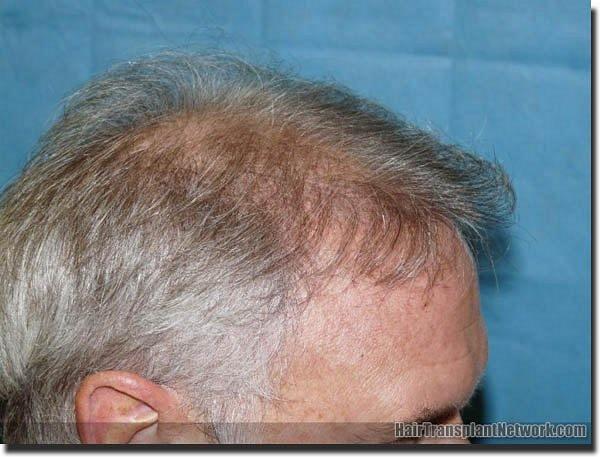 Hair restoration procedure results