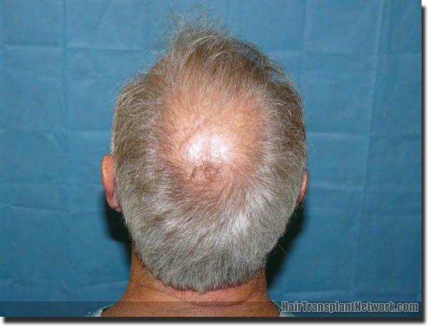 Hair restoration procedure results