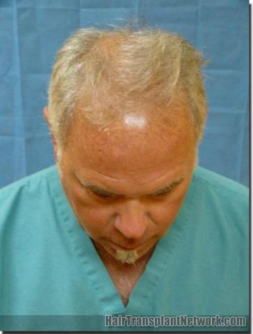 Hair restoration procedure results