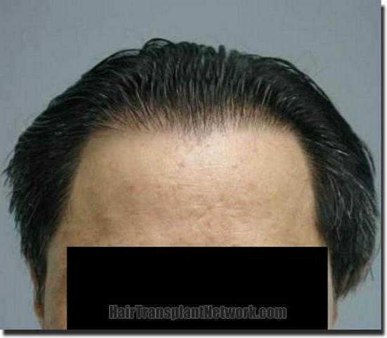 Hair restoration procedure results