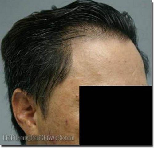 Hair restoration procedure results