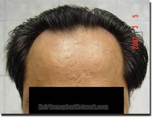 Hair restoration procedure results