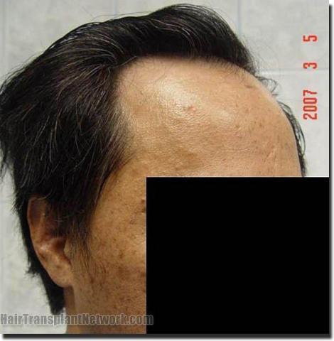 Hair restoration procedure results