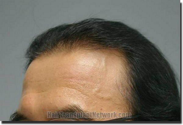 Hair restoration procedure results