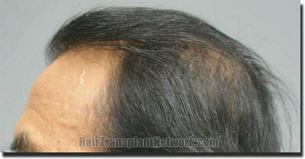 Hair restoration procedure results