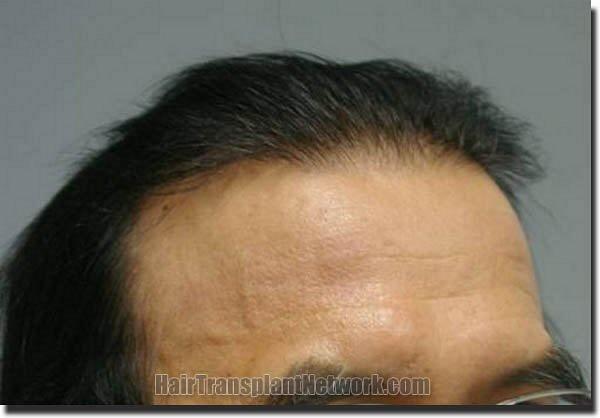 Hair restoration procedure results