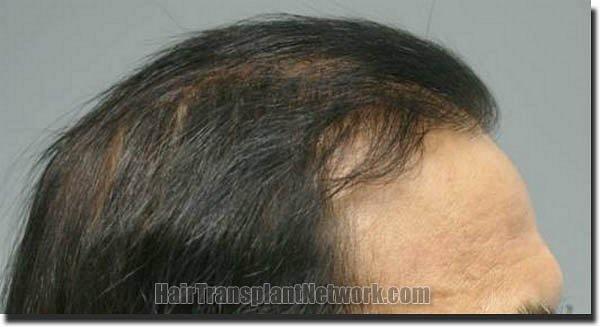 Hair restoration procedure results