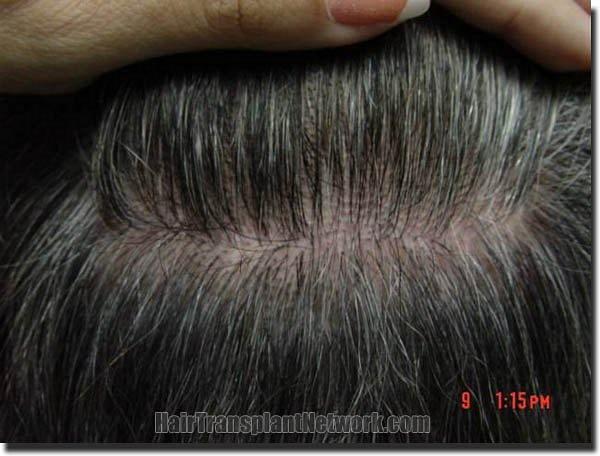 Hair restoration procedure results