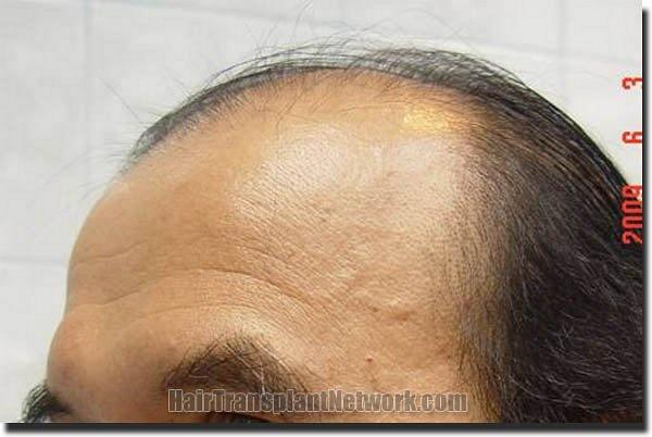 Hair restoration procedure results