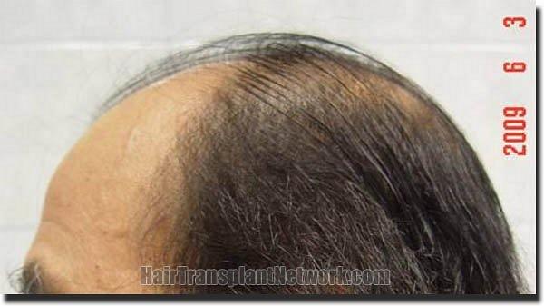 Hair restoration procedure results