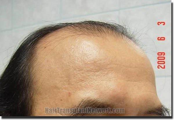 Hair restoration procedure results