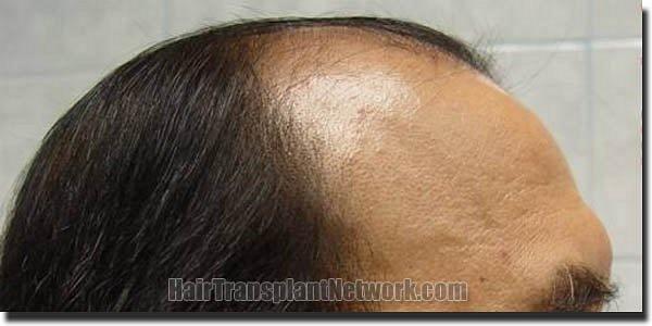 Hair restoration procedure results