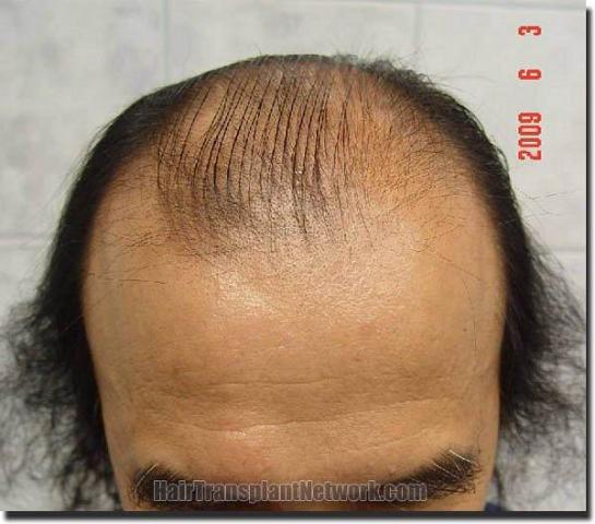 Hair restoration procedure results