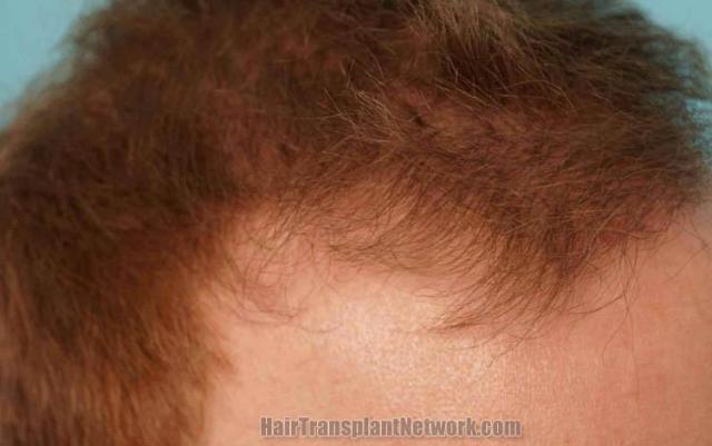 Hair transplantation surgery before and after photos