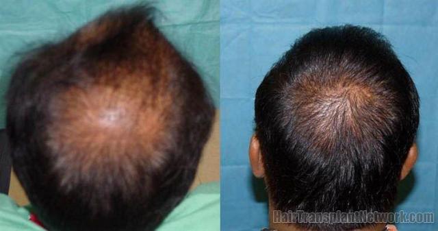 View of back before and after hair restoration procedure