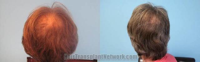 Hair restoration procedure before and after pictures