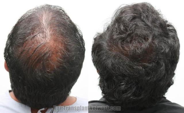 Surgical hair transplantation result photographs