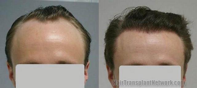 Hair transplant result photos - Front view