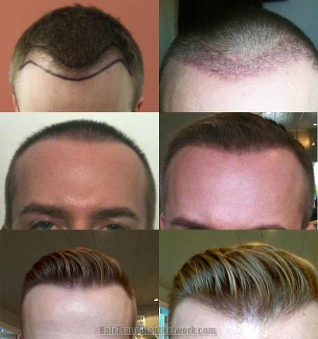 Hair restoration procedure before and after results