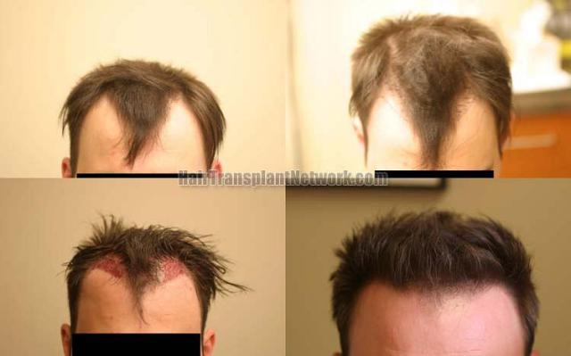 Hair restoration procedure before and after results