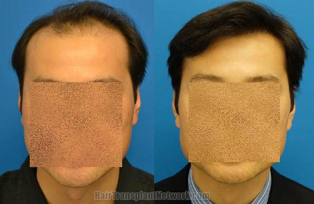 Hair restoration procedure before and after results