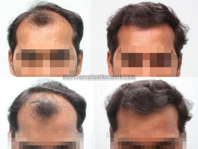 Hair restoration procedure before and after results