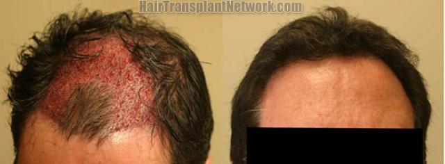 Hair restoration procedure results