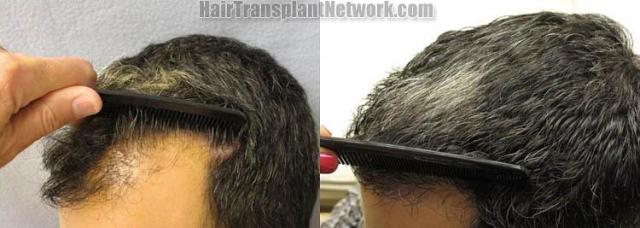 Hair restoration procedure before and after pictures