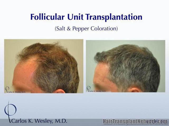 Hair transplantation surgery before and after photos