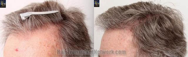 Hair transplantation surgery before and after images