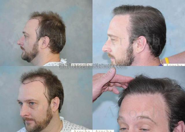 Hair transplantation surgery before and after pictures