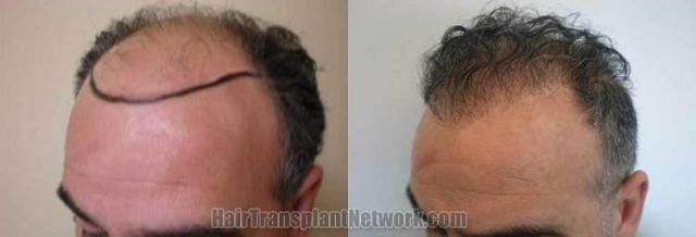 Hair transplantation surgery before and after pictures