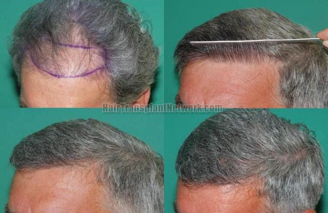 air transplantation surgery before and after photos