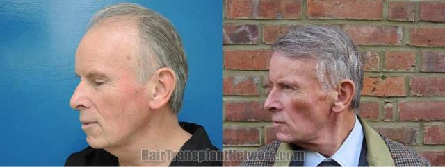 Hair restoration procedure before and after pictures