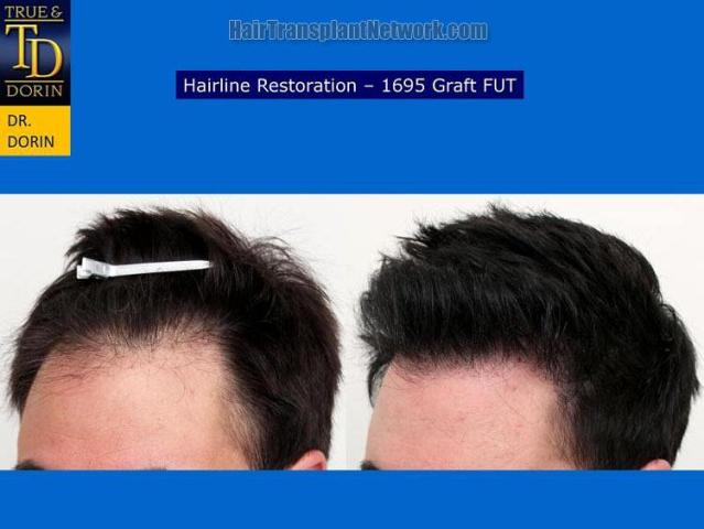 Hair transplantation surgery before and after pictures