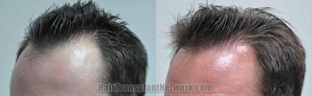 Hair transplantation surgery before and after images